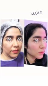 نمونه تزریق چربی (دکتر فریبا صابری)