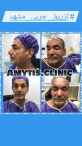 نمونه تزریق چربی (دکتر فریبا صابری)