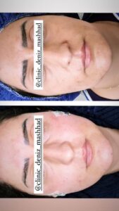 نمونه تزریق چربی (کلینیک دنیز)