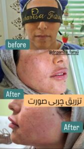 نمونه تزریق چربی (دکتر پریسا فرجی)