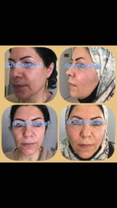 نمونه تزریق چربی (دکتر فریبا صابری)