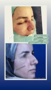 نمونه تزریق چربی (دکتر نازنین ابدالی)