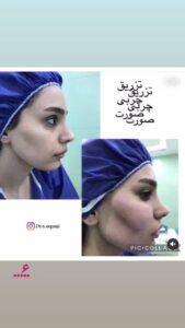 نمونه تزریق چربی (دکتر نعیمه ارگنجی)