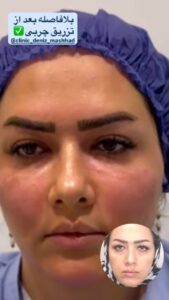 نمونه تزریق چربی (کلینیک دنیز)