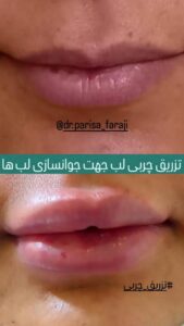 نمونه تزریق چربی (دکتر پریسا فرجی)