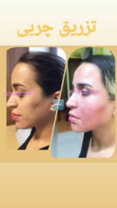 نمونه تزریق چربی (دکتر فریبا صابری)