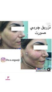 نمونه تزریق چربی (دکتر نعیمه ارگنجی)