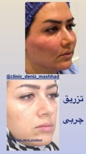 نمونه تزریق چربی (کلینیک دنیز)