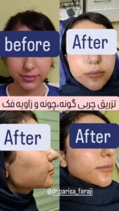 نمونه تزریق چربی (دکتر پریسا فرجی)