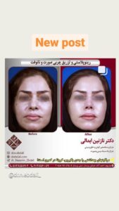 نمونه تزریق چربی (دکتر نازنین ابدالی)