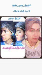 نمونه تزریق چربی (دکتر فریبا صابری)
