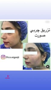 نمونه تزریق چربی (دکتر نعیمه ارگنجی)