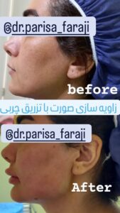 نمونه تزریق چربی (دکتر پریسا فرجی)