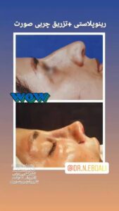 نمونه تزریق چربی (دکتر نازنین ابدالی)