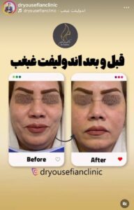 نمونه کار رفع غبغب دکتر یوسفیان در مشهد