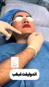 نمونه کار رفع غبغب دکتر یوسفیان در مشهد