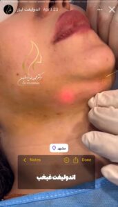 نمونه کار رفع غبغب دکتر یوسفیان در مشهد