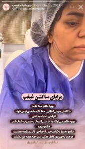 نمونه کار رفع غبغب دکتر جلال معتمدی فر در مشهد