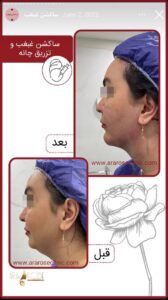نمونه کار رفع غبغب کلینیک آرارز در مشهد