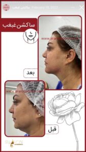 نمونه کار رفع غبغب کلینیک آرارز در مشهد