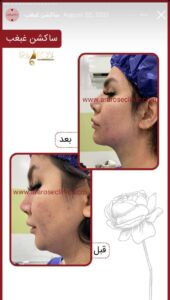 نمونه کار رفع غبغب کلینیک آرارز در مشهد