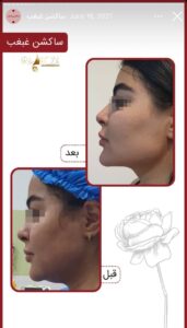 نمونه کار رفع غبغب کلینیک آرارز در مشهد