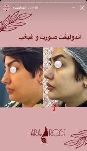 نمونه کار رفع غبغب کلینیک آرارز در مشهد