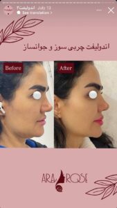 نمونه کار رفع غبغب کلینیک آرارز در مشهد