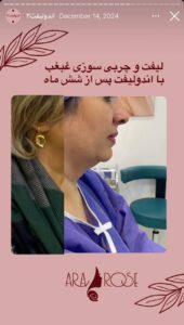 نمونه کار رفع غبغب کلینیک آرارز در مشهد