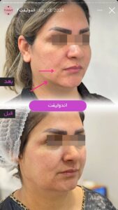 نمونه کار رفع غبغب کلینیک آرارز در مشهد