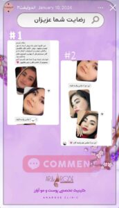 نمونه کار رفع غبغب کلینیک آرارز در مشهد