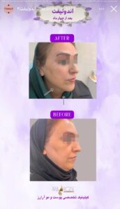 نمونه کار رفع غبغب کلینیک آرارز در مشهد