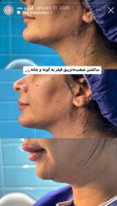نمونه کار رفع غبغب کلینیک سلامت ایده آل در مشهد