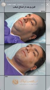 نمونه کار رفع غبغب کلینیک سلامت ایده آل در مشهد