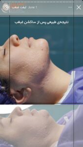نمونه کار رفع غبغب کلینیک سلامت ایده آل در مشهد