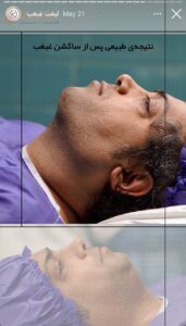 نمونه کار رفع غبغب کلینیک سلامت ایده آل در مشهد