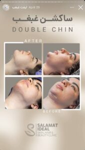 نمونه کار رفع غبغب کلینیک سلامت ایده آل در مشهد