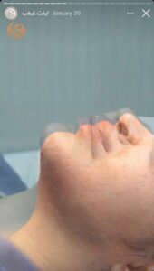 نمونه کار رفع غبغب کلینیک سلامت ایده آل در مشهد
