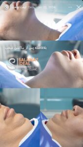 نمونه کار رفع غبغب کلینیک سلامت ایده آل در مشهد
