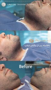 نمونه کار رفع غبغب کلینیک سلامت ایده آل در مشهد