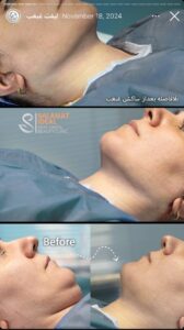 نمونه کار رفع غبغب کلینیک سلامت ایده آل در مشهد