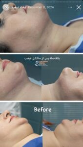 نمونه کار رفع غبغب کلینیک سلامت ایده آل در مشهد