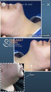 نمونه کار رفع غبغب کلینیک سلامت ایده آل در مشهد