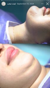 نمونه کار رفع غبغب کلینیک سلامت ایده آل در مشهد