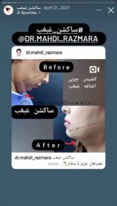 نمونه کار رفع غبغب دکتر مهدی رزم آرا در مشهد