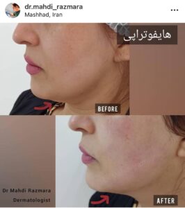 نمونه کار رفع غبغب دکتر مهدی رزم آرا در مشهد