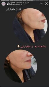 نمونه کار رفع غبغب دکتر الهه اندخشیده در مشهد