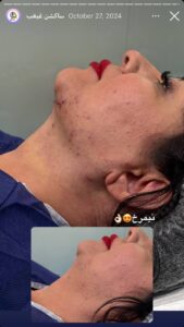نمونه کار رفع غبغب دکتر نعیمه ارگنجی