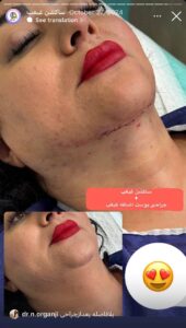 نمونه کار رفع غبغب دکتر نعیمه ارگنجی