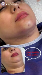نمونه کار رفع غبغب دکتر نعیمه ارگنجی